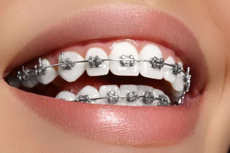 Orthodontic Treatment: Braces & Aligners