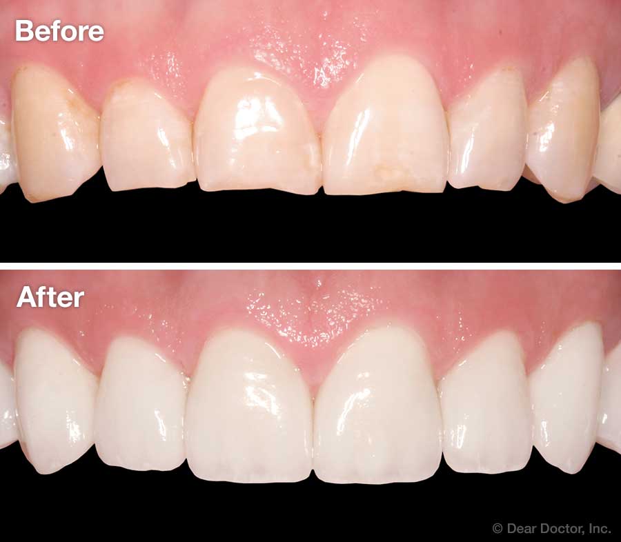 Digital Smile Design – Veneers, Laminates & Crowns