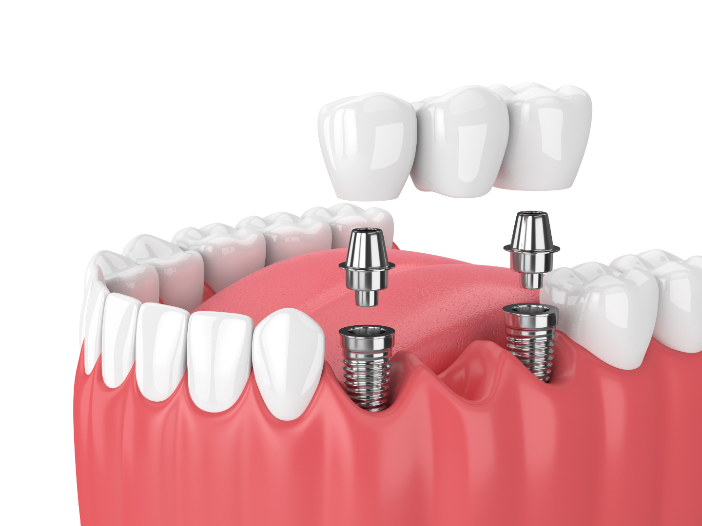 Dental Implants for a Confident Smile