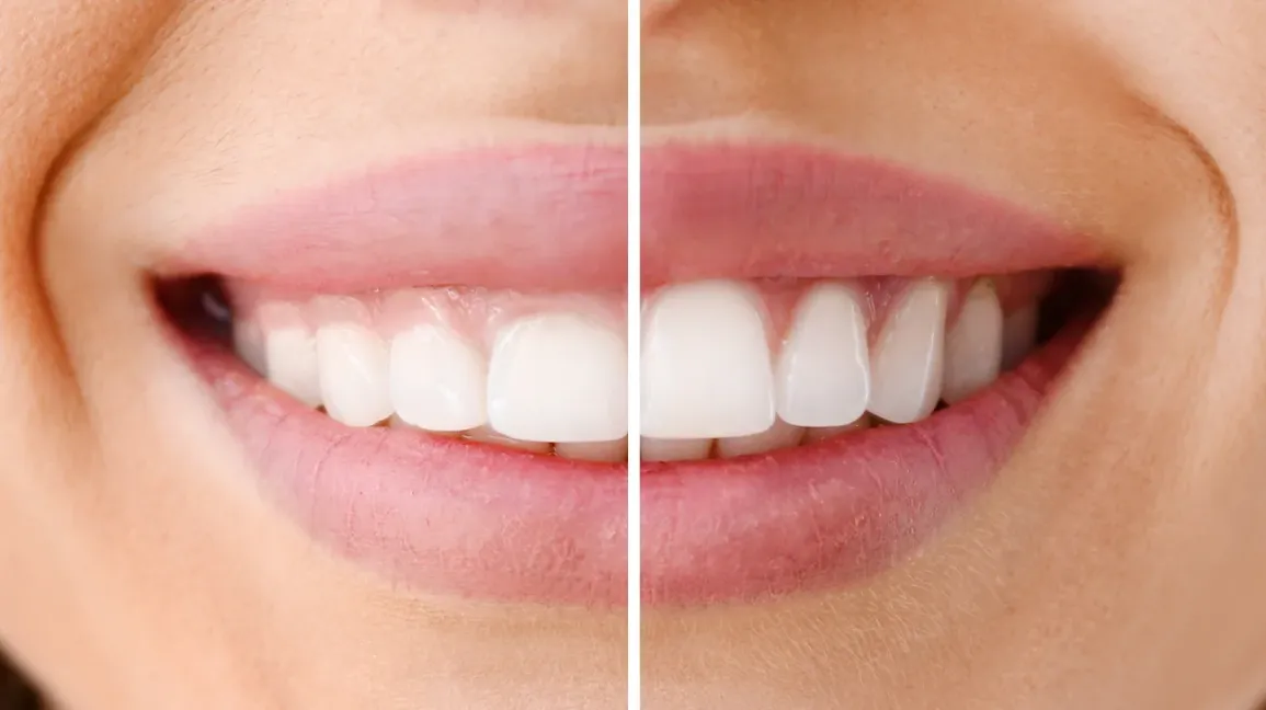 Gum Surgery for Healthy Gums & Smile