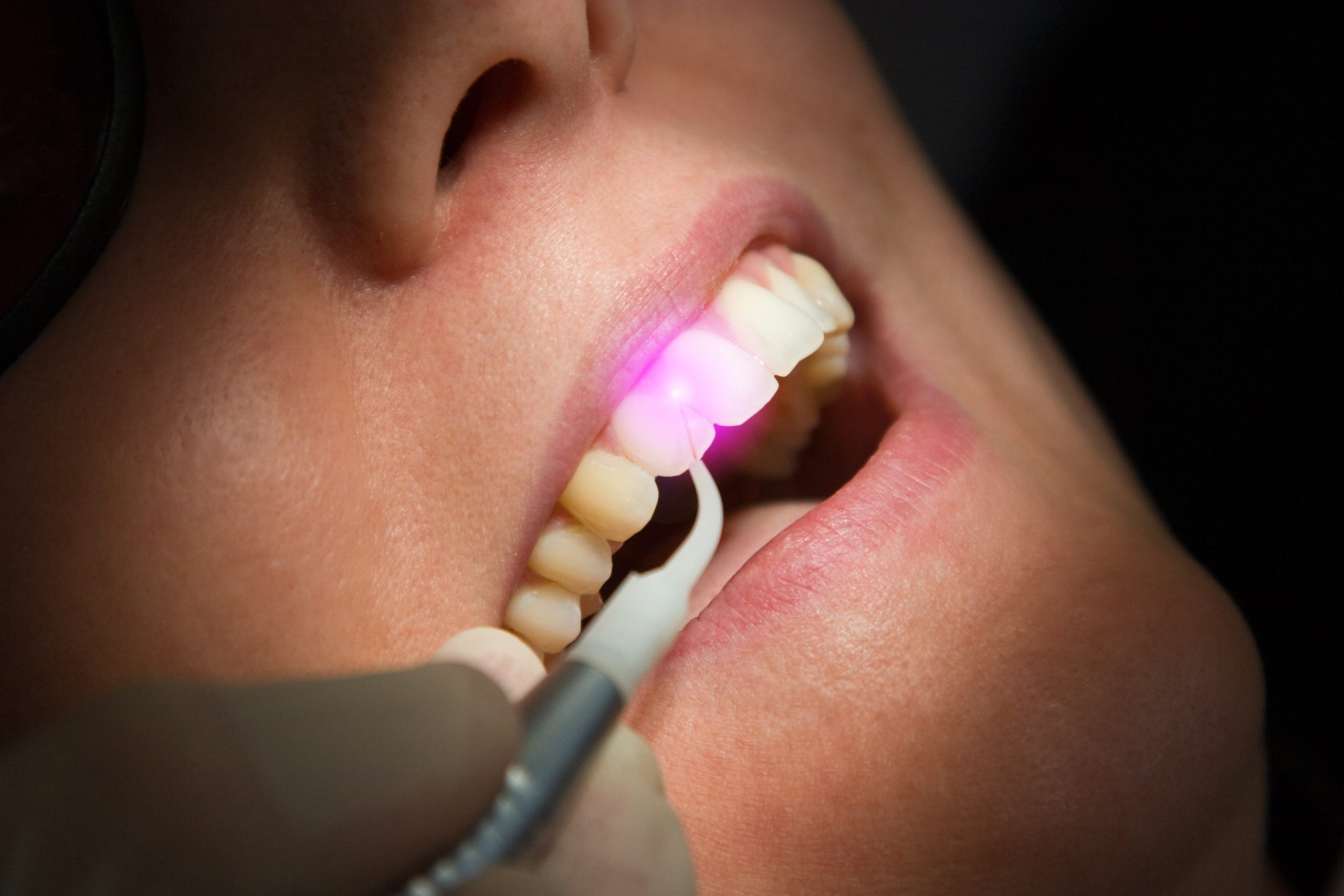 Laser Dentistry: Painless Precision at Realign Dental