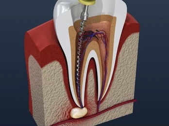 Root Canal Treatment