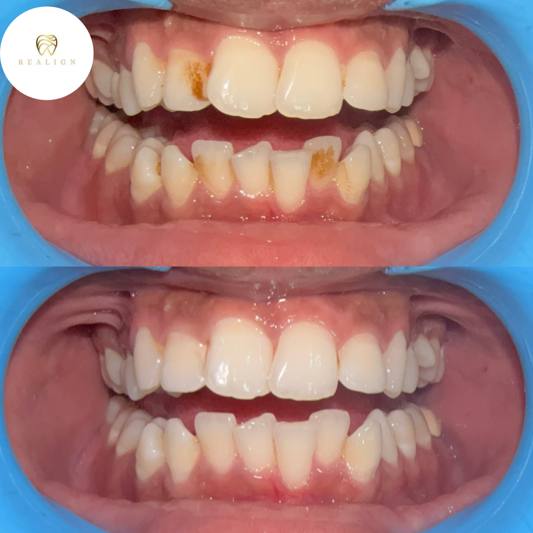 Scaling and Polishing