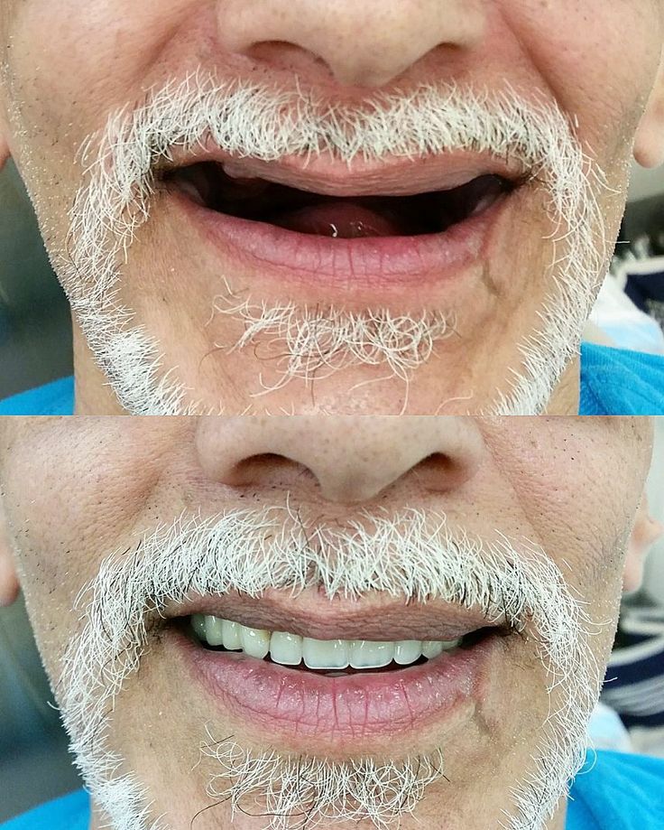 Complete Dentures (Removable & Fixed)