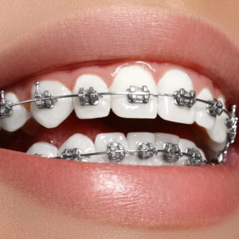 Orthodontic Treatment: Braces & Aligners