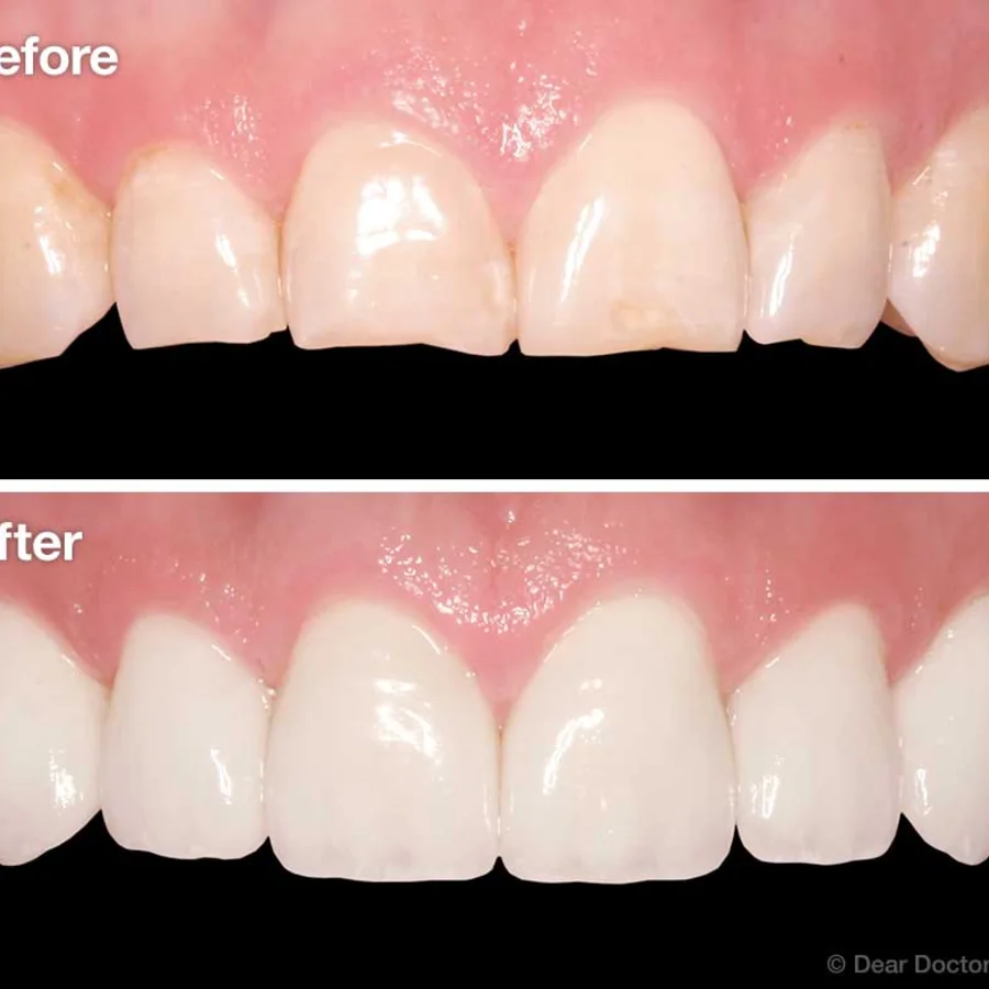 Digital Smile Design – Veneers, Laminates & Crowns