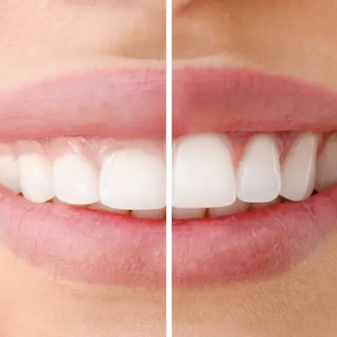 Gum Surgery for Healthy Gums & Smile