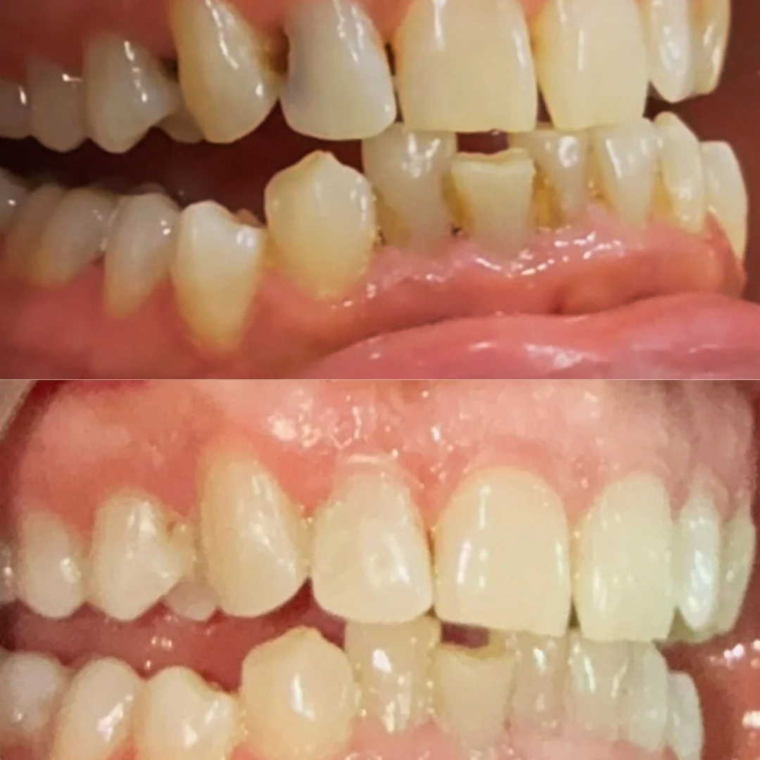 Dental Restorations: Restore Your Smile