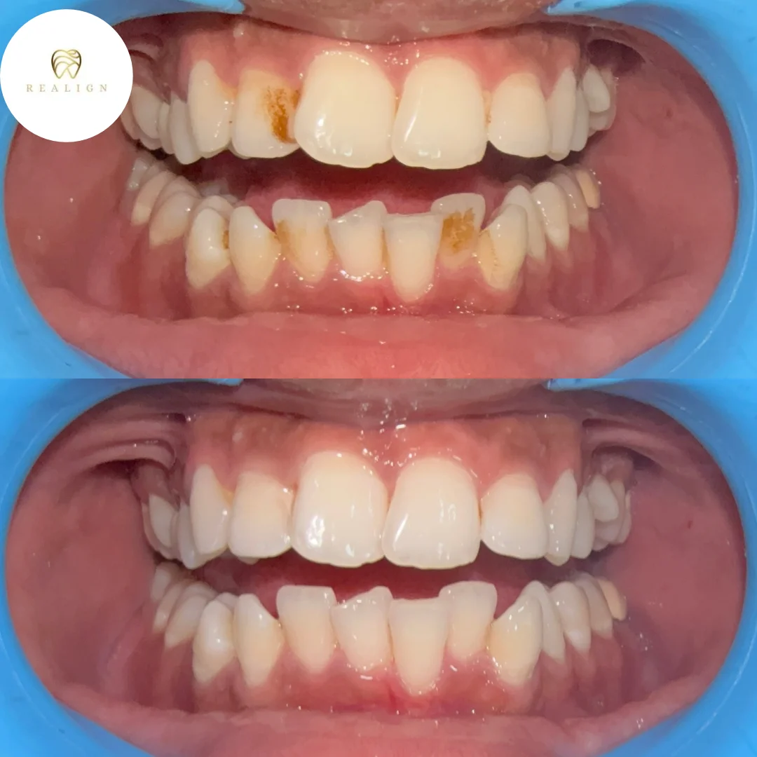 Scaling and Polishing