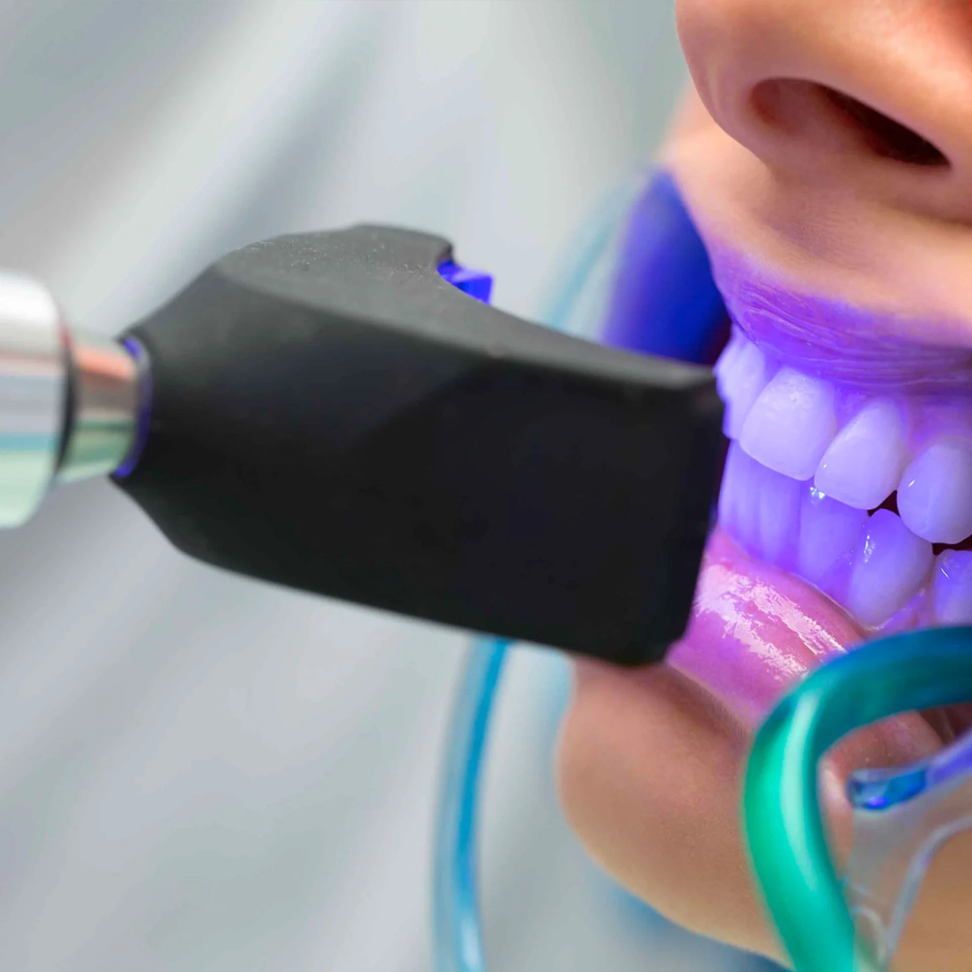 Teeth Whitening (Bleaching)