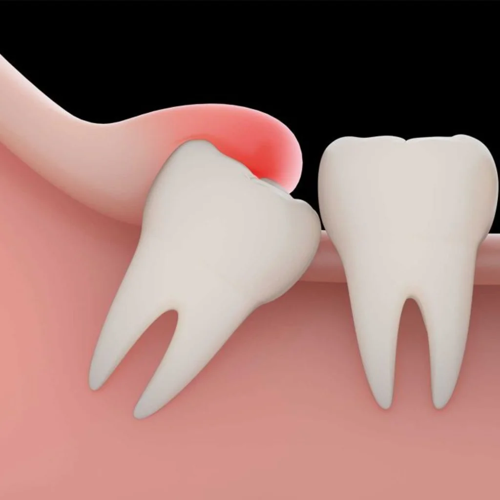 Wisdom Tooth Treatment