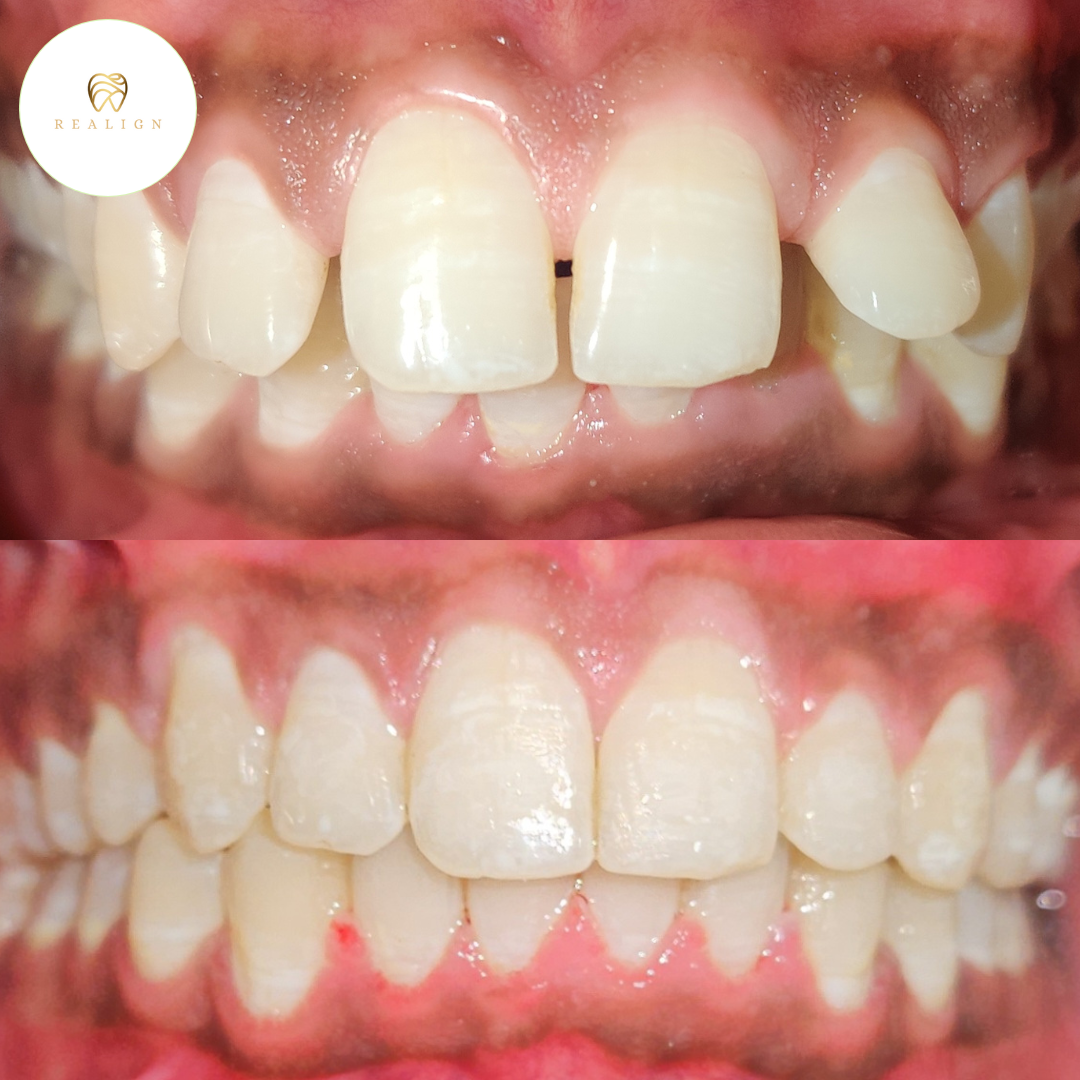 Orthodontic Treatment: Braces & Aligners