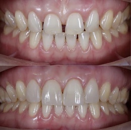 Digital Smile Design – Veneers, Laminates & Crowns