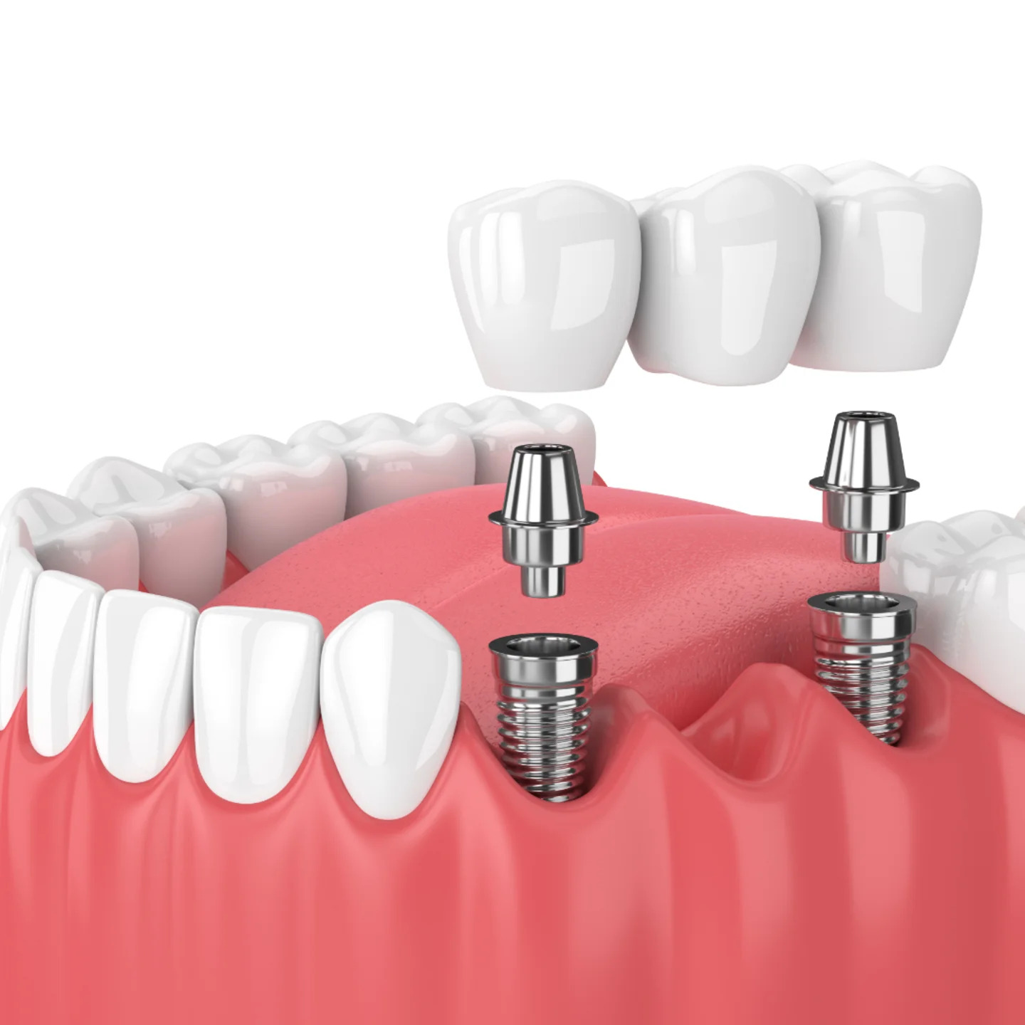 Dental Implants for a Confident Smile