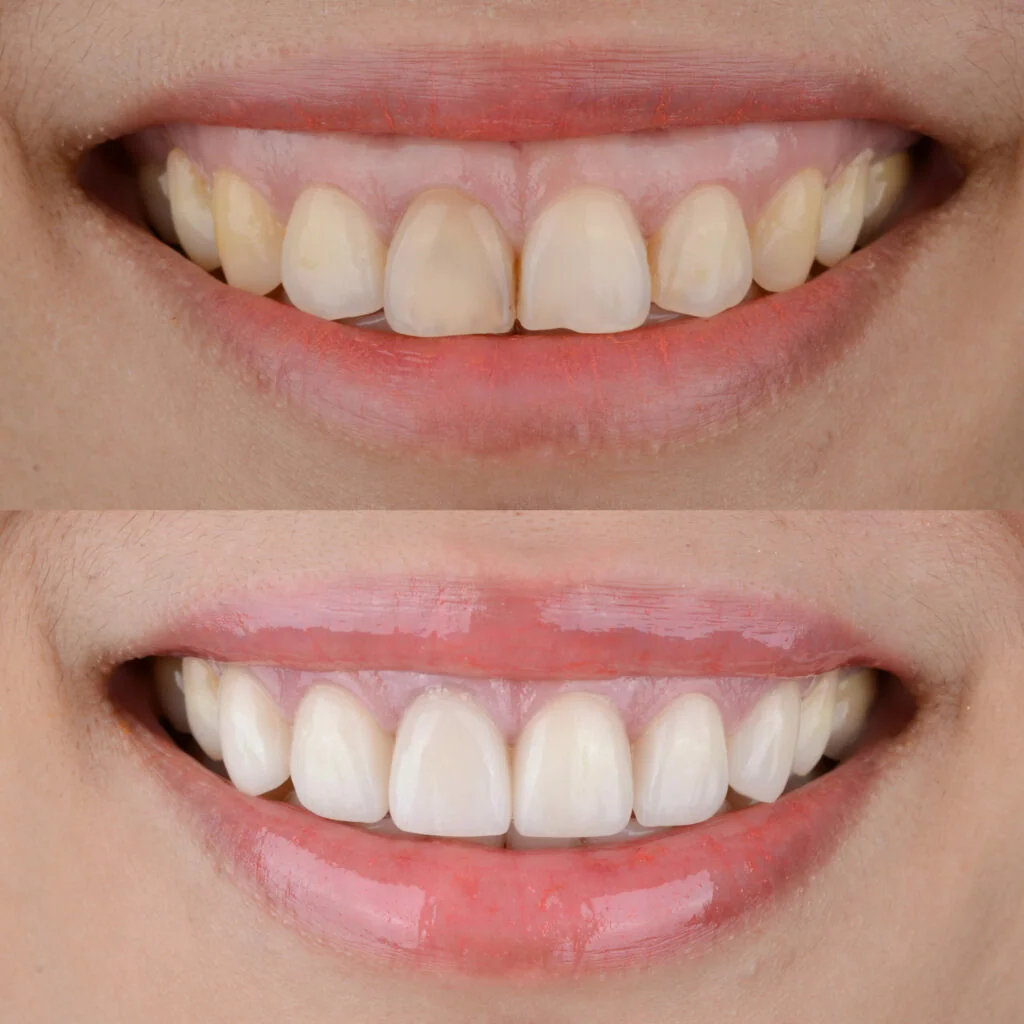 Gum Surgery for Healthy Gums & Smile