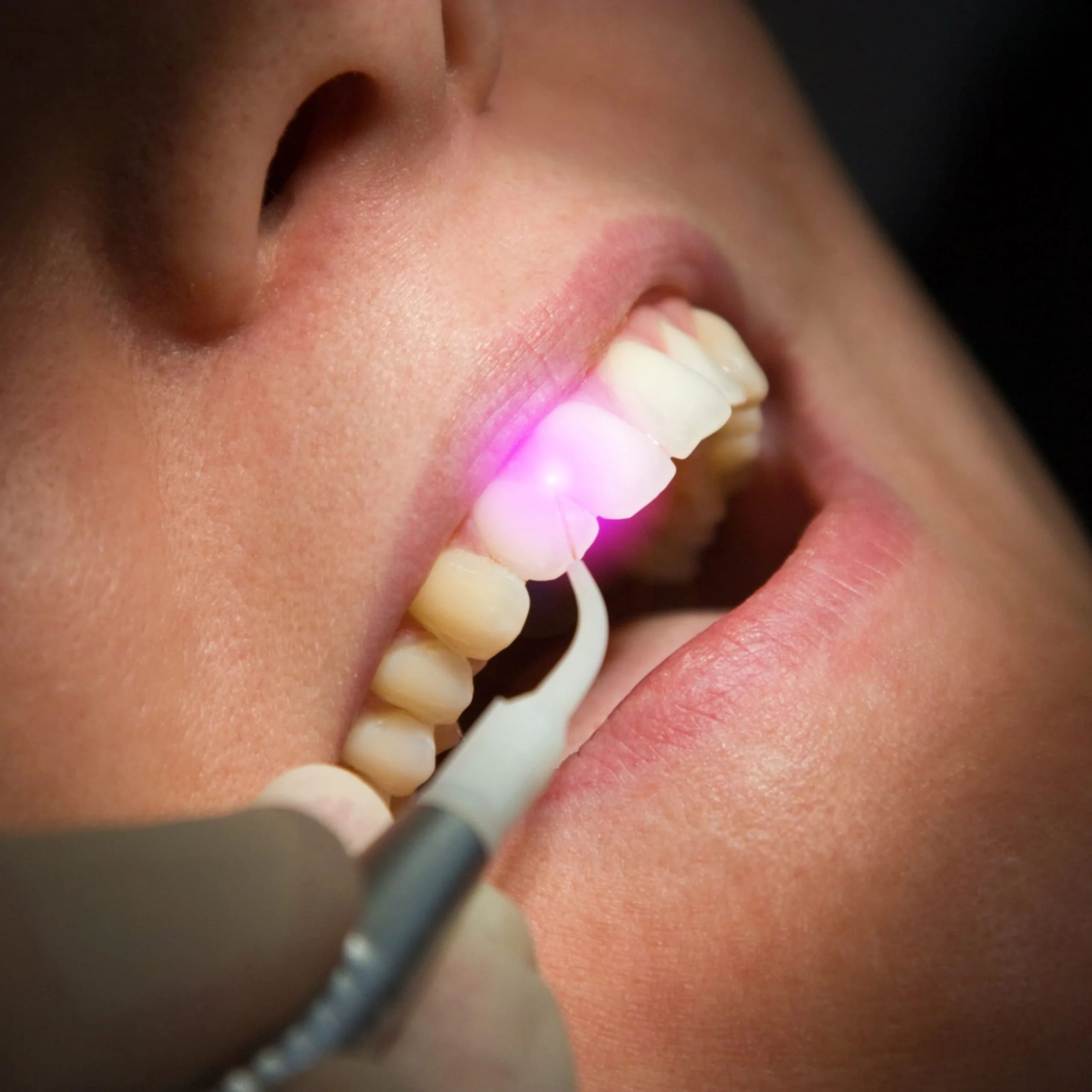 Laser Dentistry: Painless Precision at Realign Dental