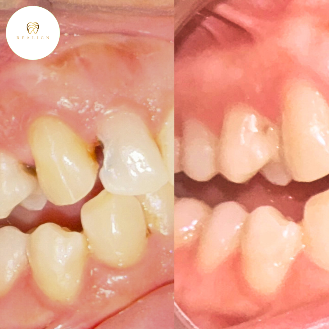 Dental Restorations: Restore Your Smile