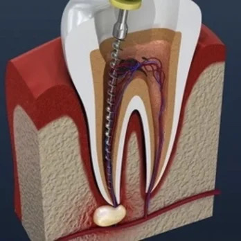 Root Canal Treatment