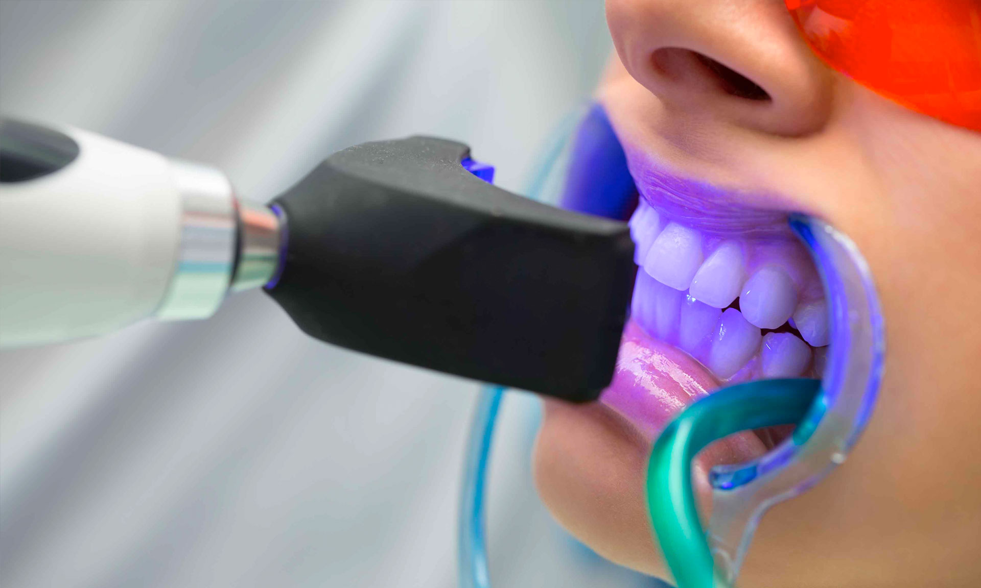 Teeth Whitening (Bleaching)