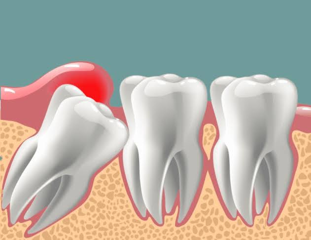 Wisdom Tooth Treatment