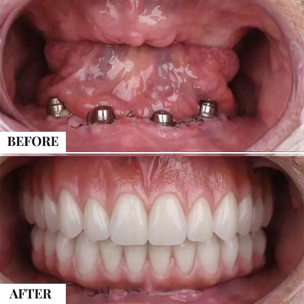 Complete Dentures (Removable & Fixed)
